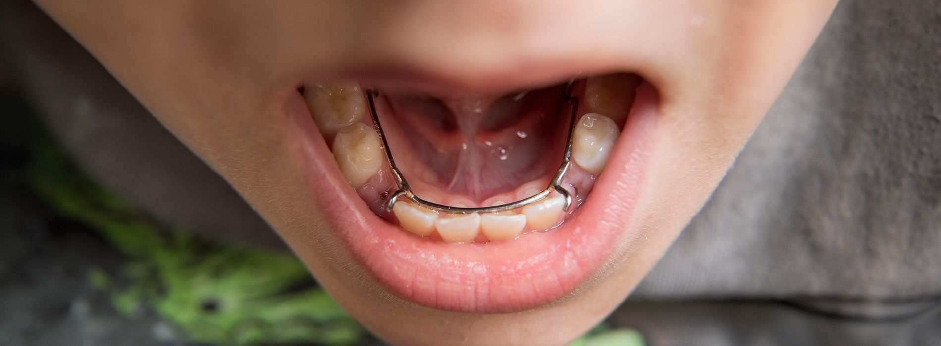 An individual with a visible orthodontic appliance, showing their teeth, positioned against a blurred background.