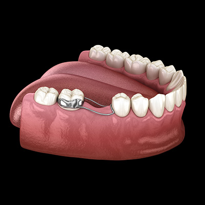 The image shows a 3D rendering of an open mouth with teeth and a visible dental implant.